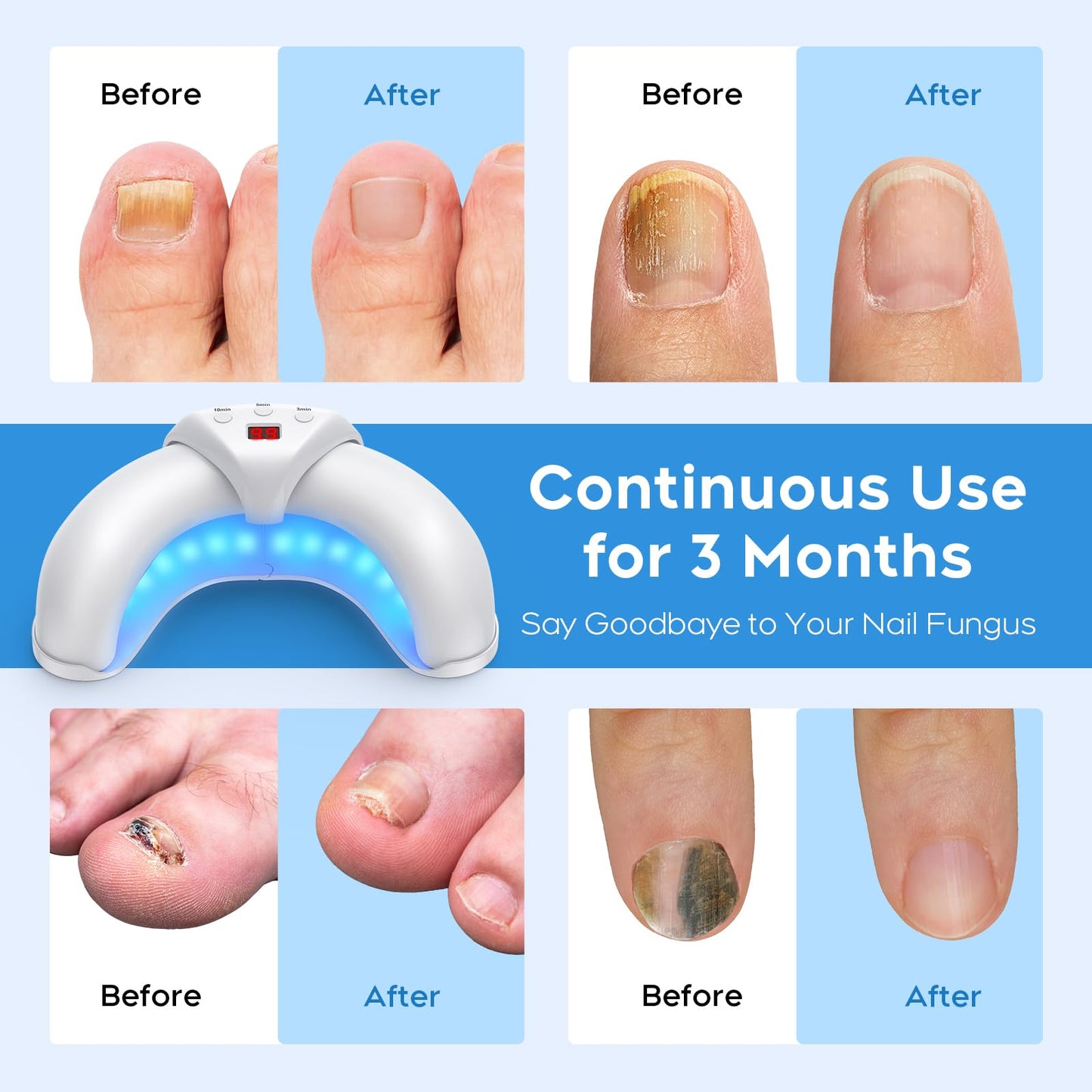 ✨ Home Laser Toenail & Fingernail Fungus Device — Drug-Free Renewal for Your Nails ✨